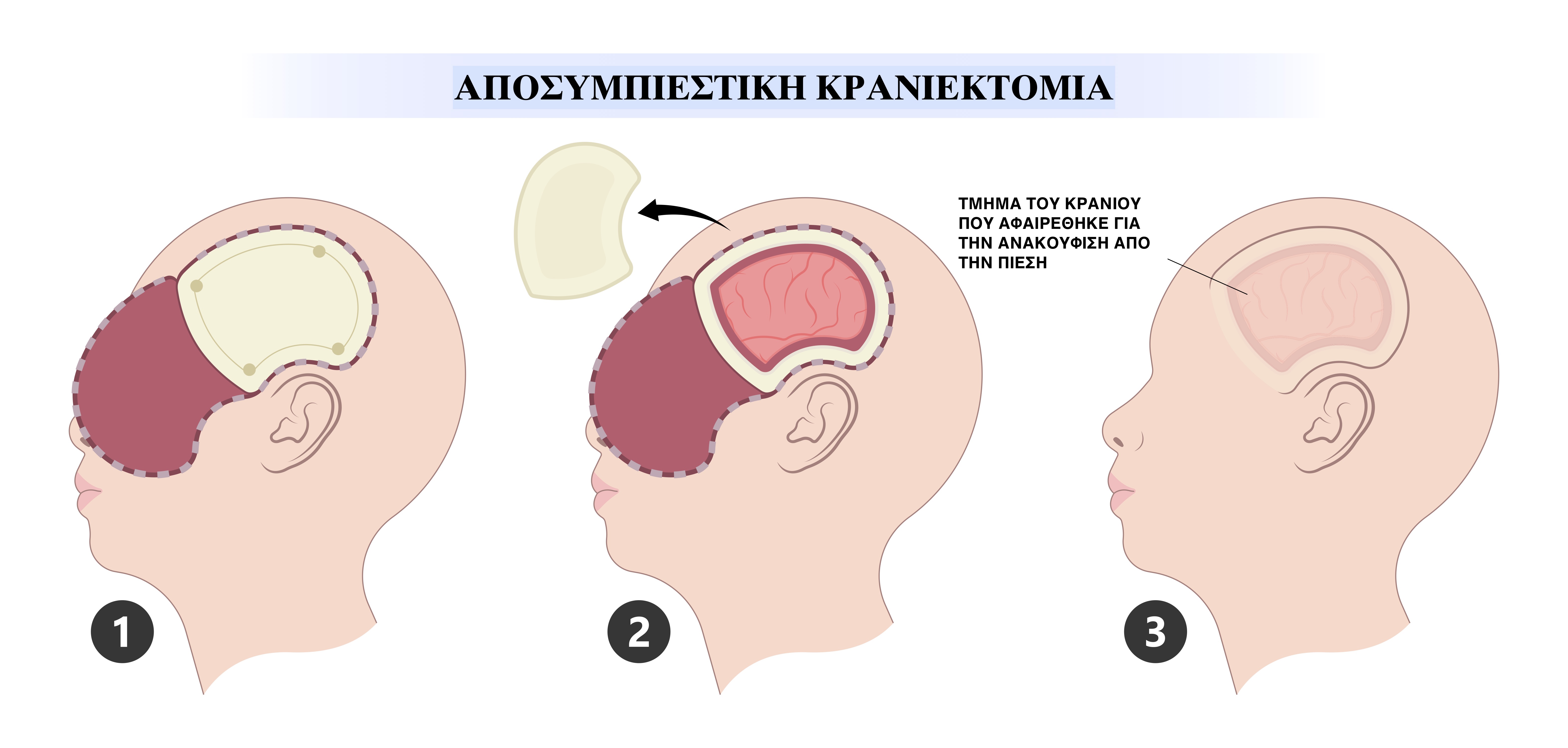 ΑΠΟΣΥΜΠΙΕΣΤΙΚΗ ΚΡΑΝΙΕΚΤΟΜΙΑ ΓΙΑ ΤΗΝ ΑΝΤΙΜΕΤΩΠΙΣΗ ΟΙΔΗΜΑΤΟΣ ΜΕΤΑ ΑΠΟ ΚΡΑΝΙΟΕΓΚΕΦΑΛΙΚΗ ΚΆΚΩΣΗ ΑΠΟΣΥΜΠΙΕΣΤΙΚΗ ΚΡΑΝΙΕΚΤΟΜΙΑ ΓΙΑ ΤΗΝ ΑΝΤΙΜΕΤΩΠΙΣΗ ΟΙΔΗΜΑΤΟΣ ΜΕΤΑ ΑΠΟ ΚΡΑΝΙΟΕΓΚΕΦΑΛΙΚΗ ΚΆΚΩΣΗ